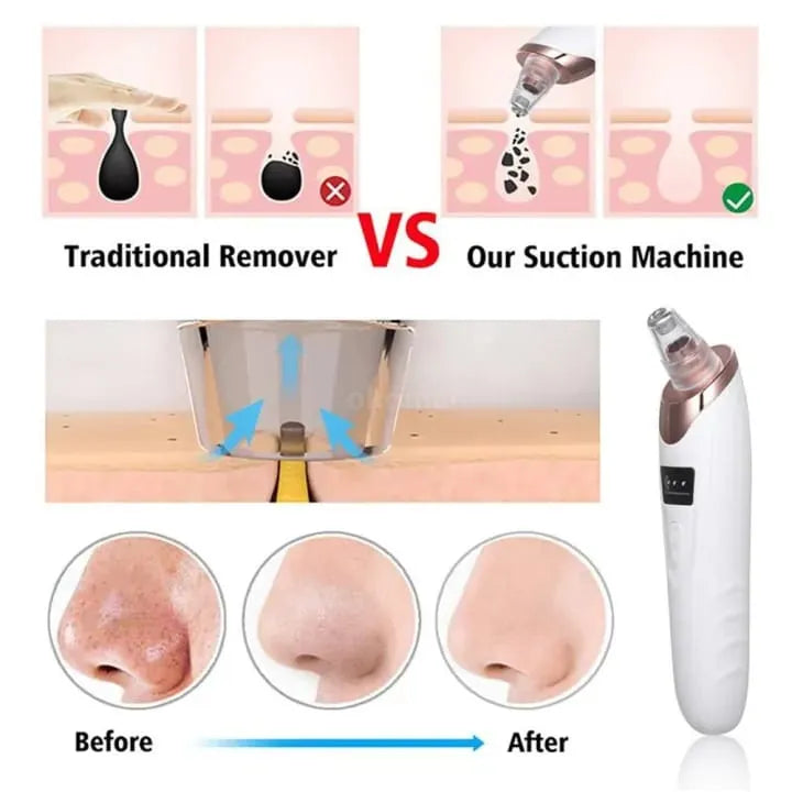 💕⚡ Face Vacuum Suction Blackhead Remover – Electric Deep Pore Cleansing Tool for Nose & Face 🌸